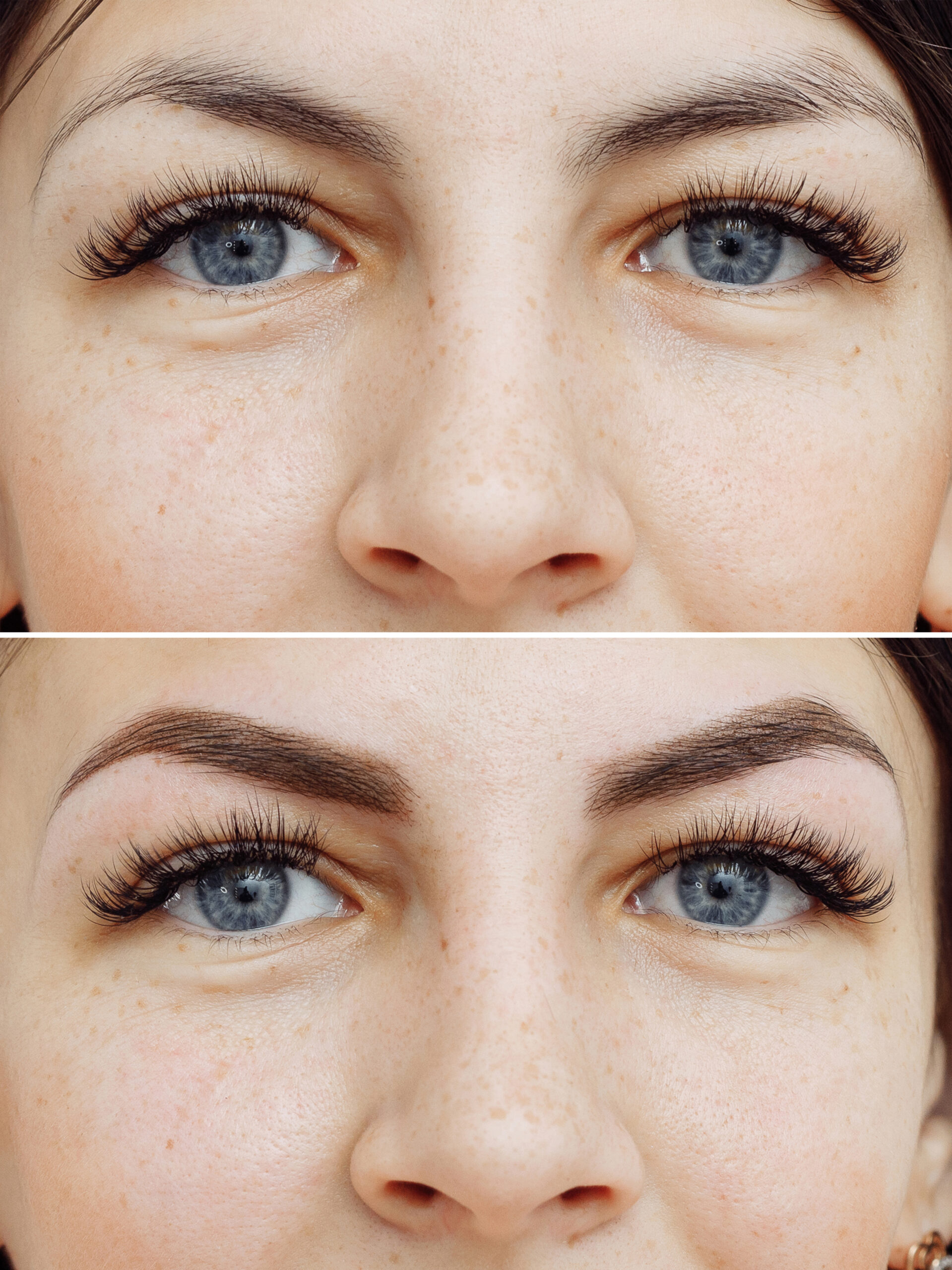 Brow correction