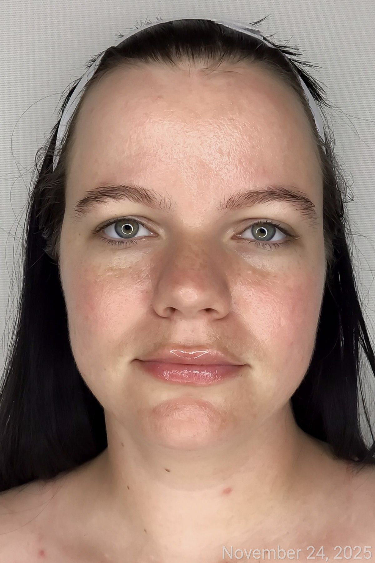 Compromised Skin After
