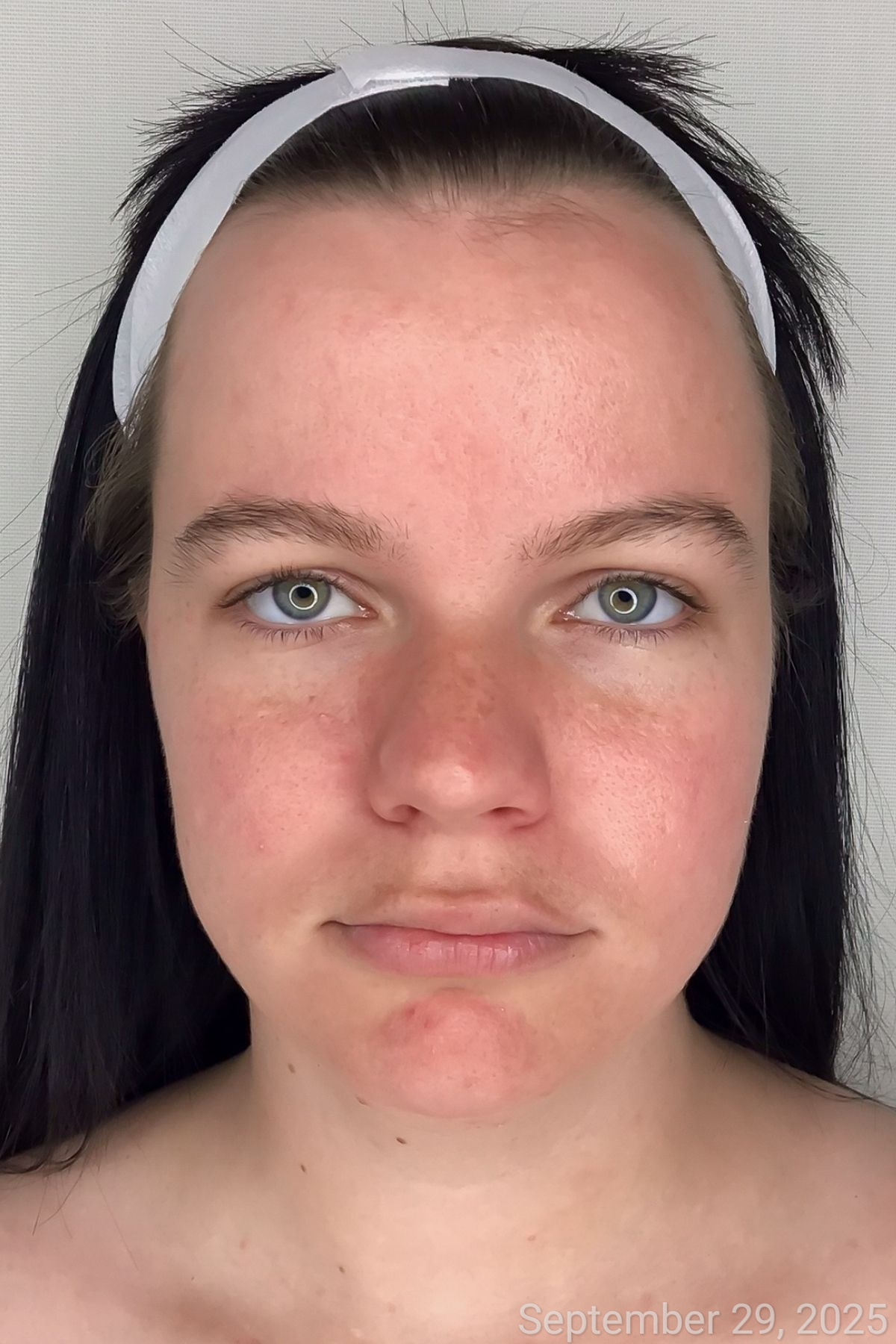 Compromised Skin Before