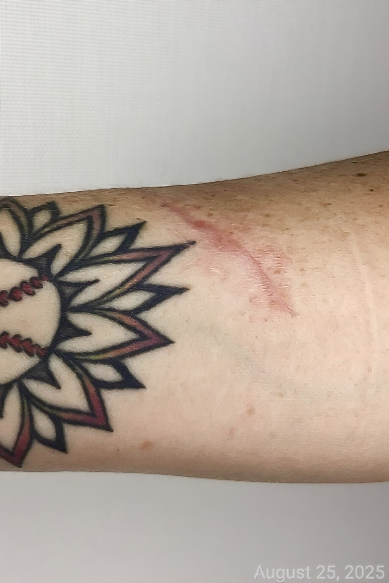 Scar Revision After