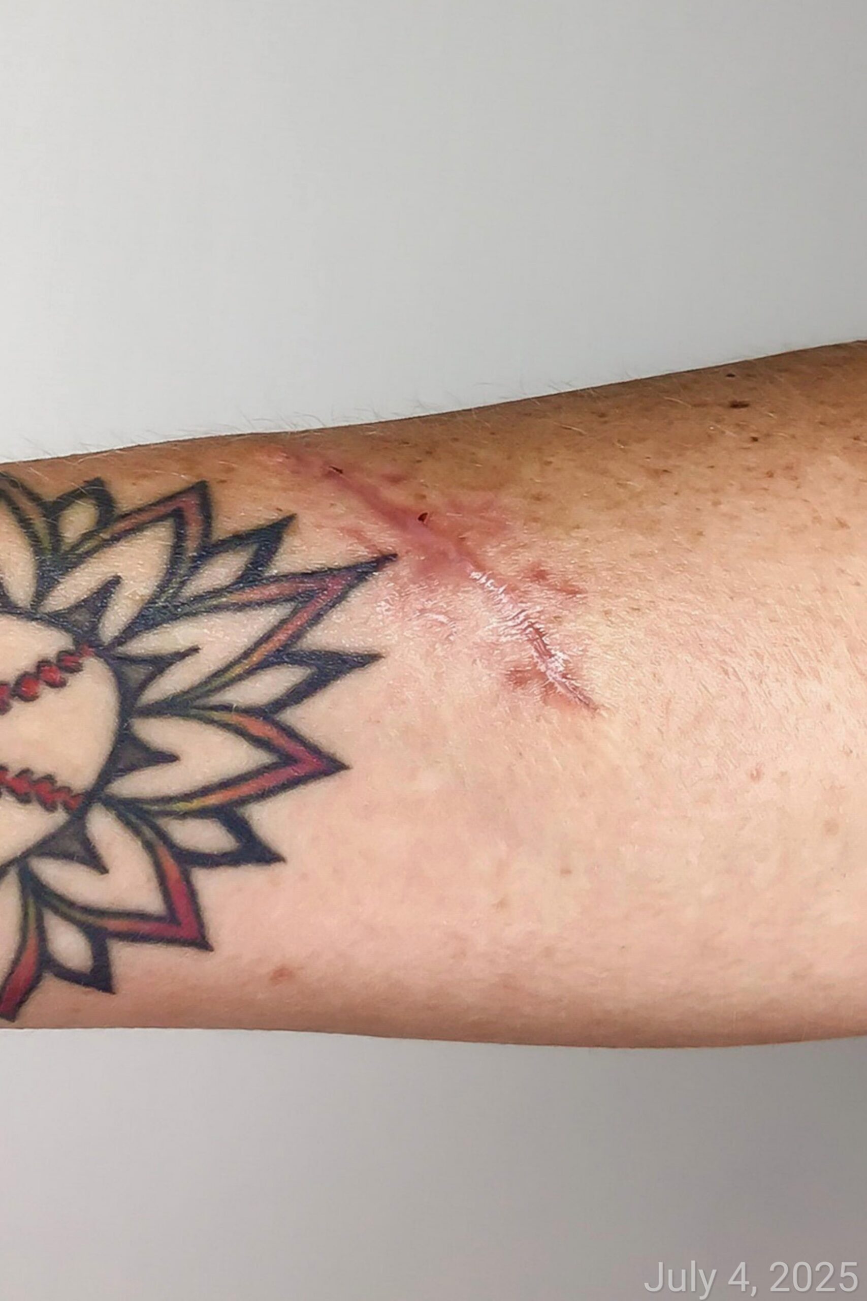 Scar Revision Before