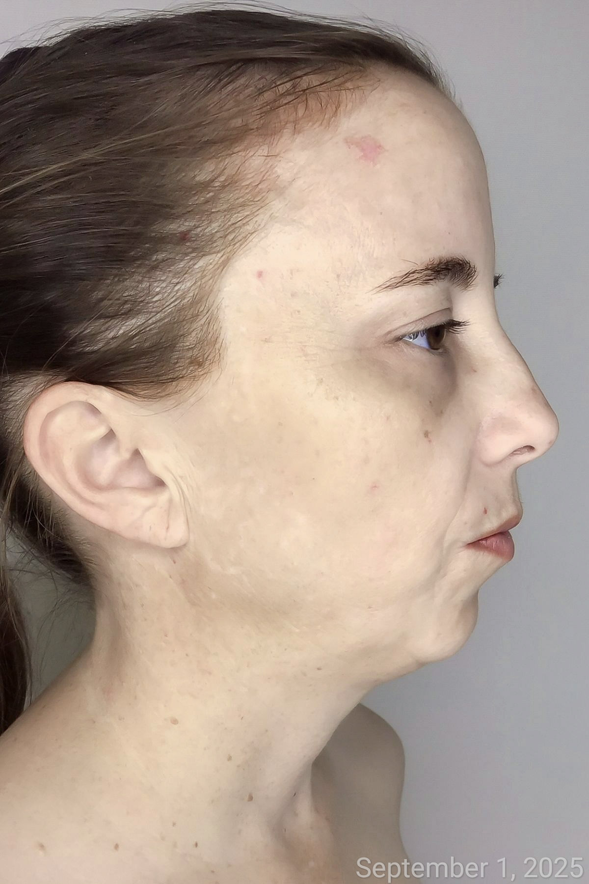 Pigmentation After