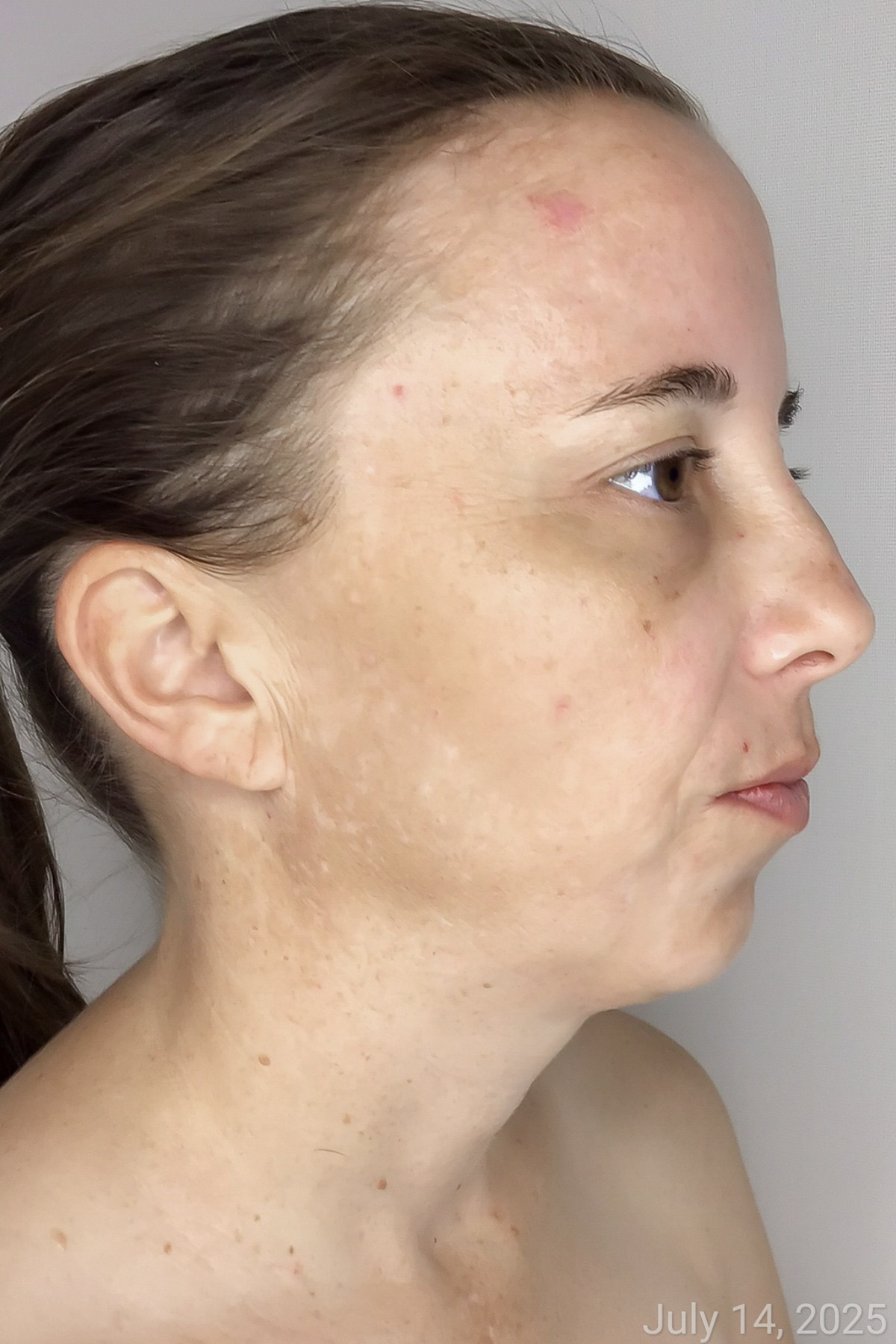 Pigmentation Before