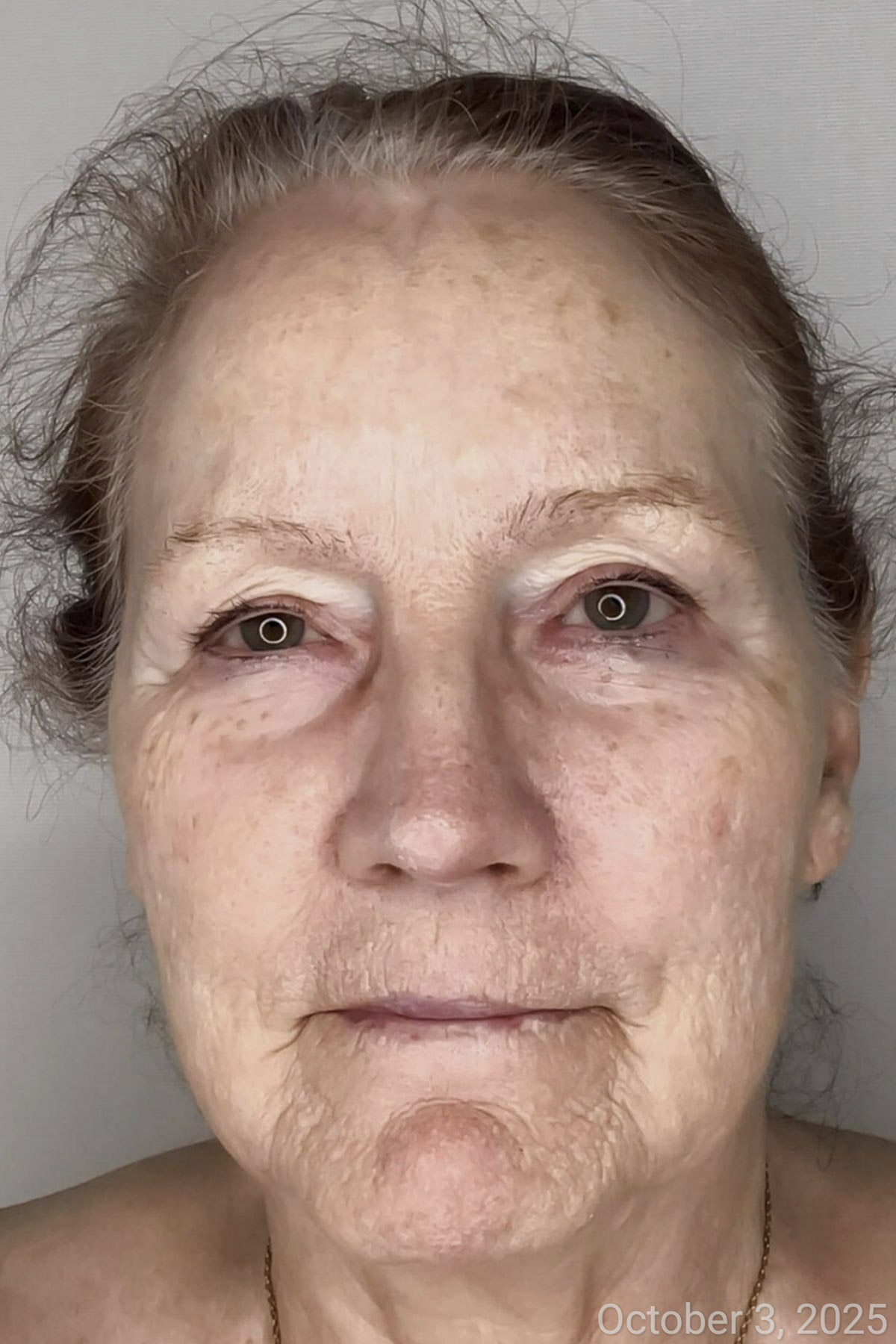Skin after chemical peel