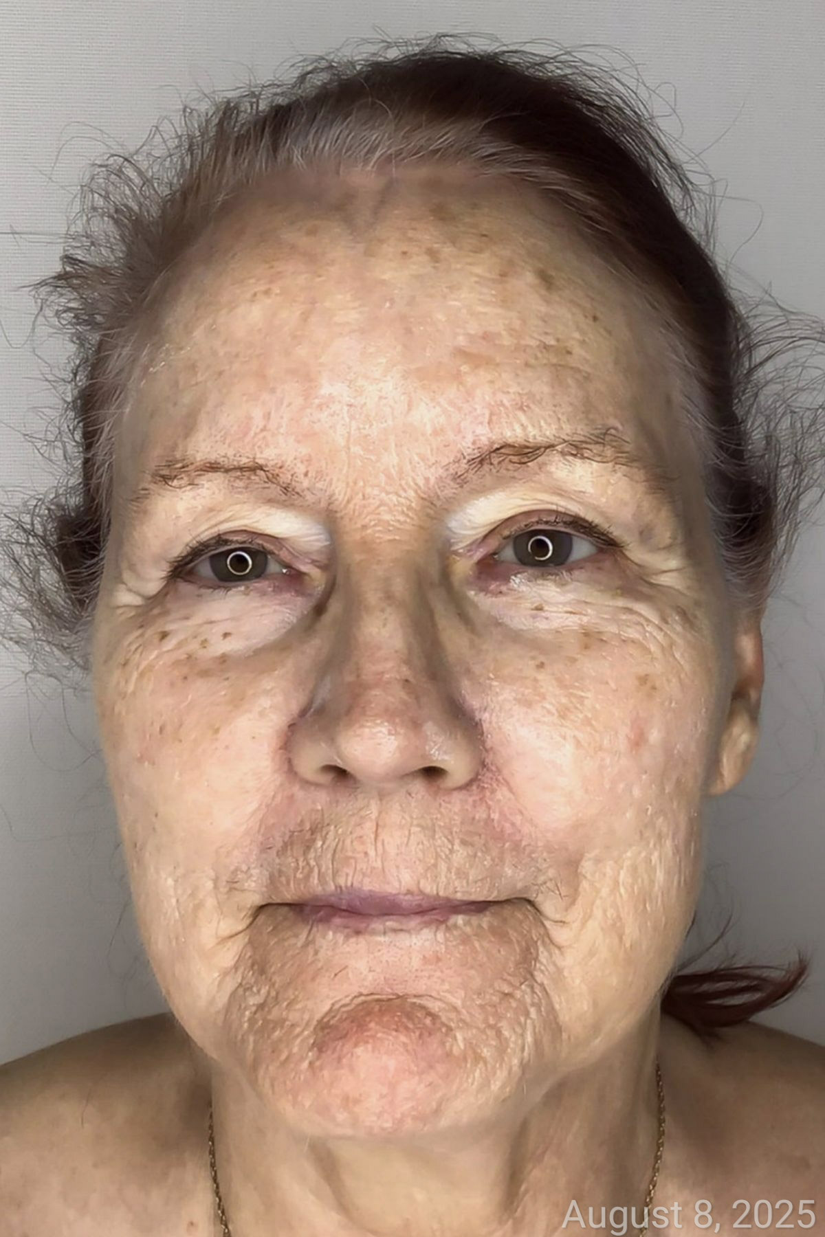 Skin before chemical peel